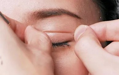 割双眼皮手术恢复时间