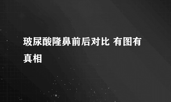 玻尿酸隆鼻前后对比 有图有真相
