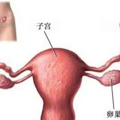 盆腔疾病有哪些?