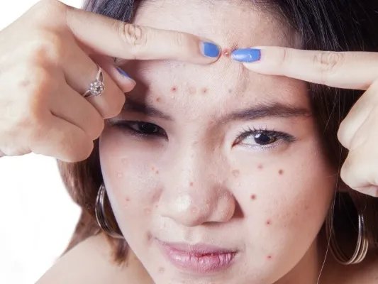 为什么会长色斑