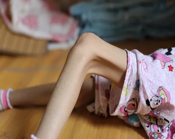 张若昀瘦到青筋凸起，过于消瘦对身体有何危害？