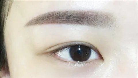 激光祛眼袋多少钱