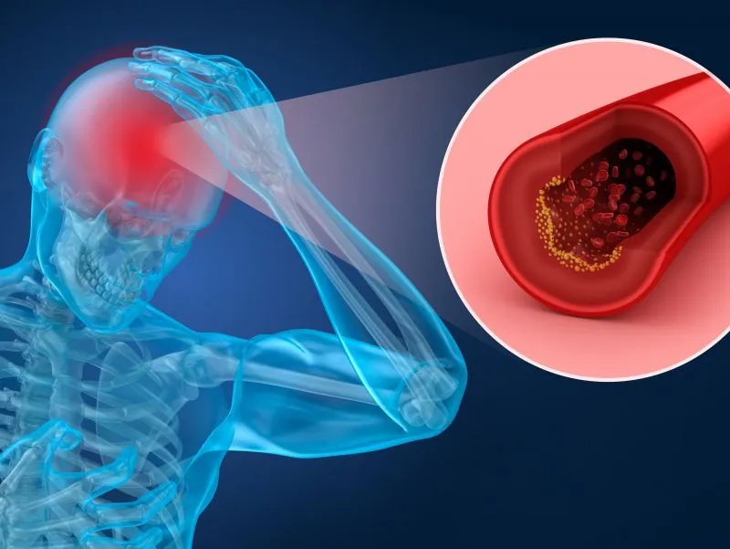 脑梗塞不能吃什么