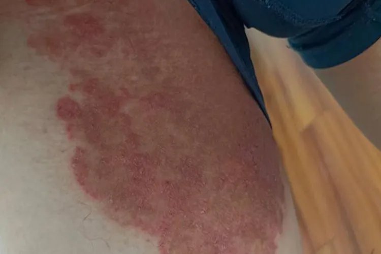 身上长了一些像癣一样的皮肤图片