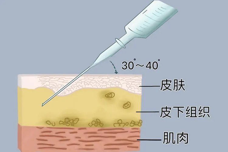 皮下如何进针图解