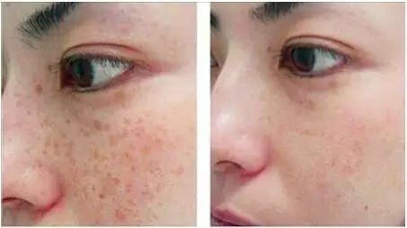 北京彩光嫩肤祛斑治疗注意事项