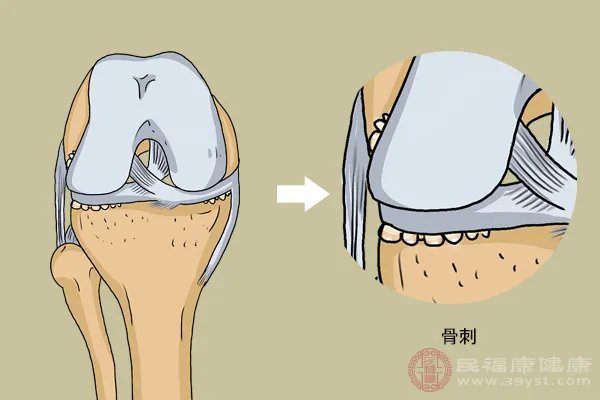 骨刺的最佳治疗方法是什么