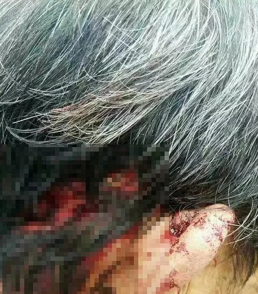 云南一老人四年两次被熊袭击是怎么回事？