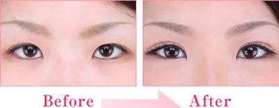 韩式双眼皮术前后有何不同