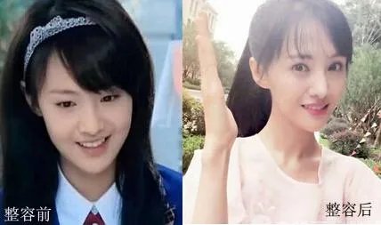你们觉得郑爽整容前漂亮还是整容后漂亮？