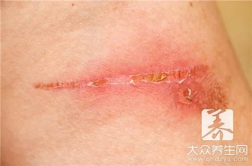 伤口愈合期间不能吃什么