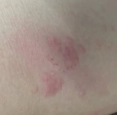 两腿之间长湿疹的症状