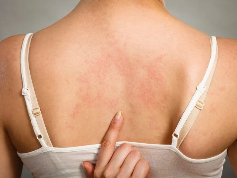 水土不服皮肤过敏怎么办