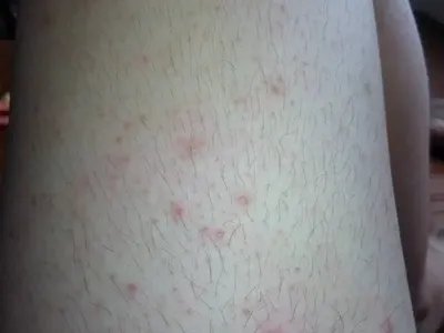 单纯性痒疹大腿症状图片