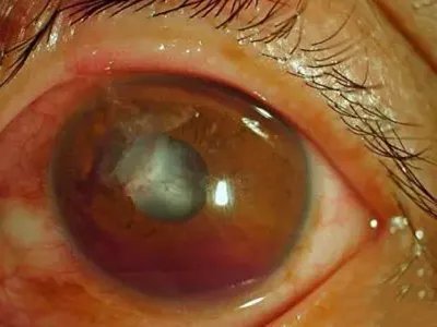 外伤性白内障症状图片