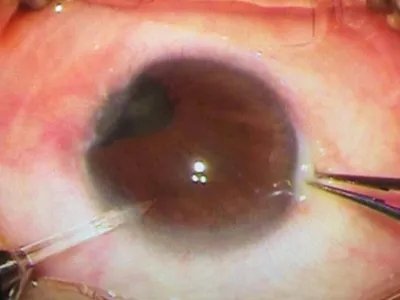 外伤性白内障症状图片