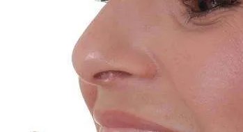 假体隆鼻术后效果自然吗