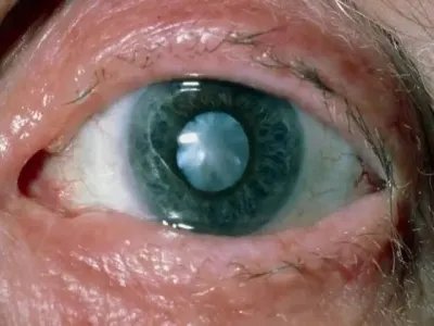 外伤性白内障症状图片