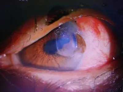 外伤性白内障症状图片