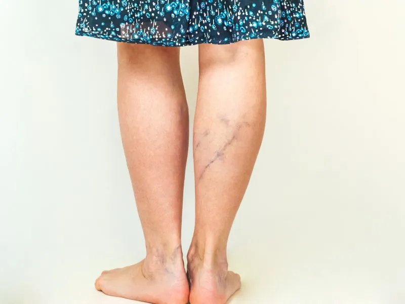 静脉曲张的治疗