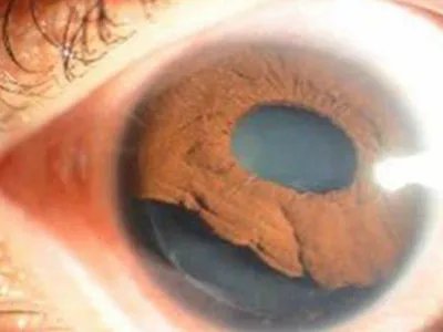 外伤性白内障症状图片