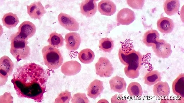 兰州兽研所布病事件，致附近3000多居民染病，感染布鲁氏菌对人体健康影响有多大？那些感染布病的居民现状如何？