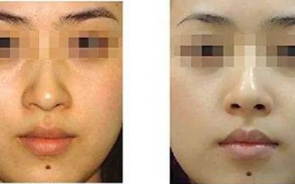 光子嫩肤美白效果