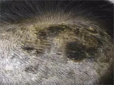 黑点癣头皮症状图片