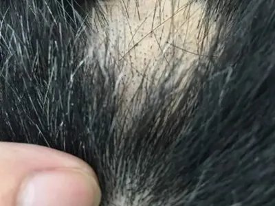 黑点癣头皮症状图片