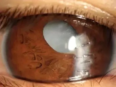 外伤性白内障症状图片