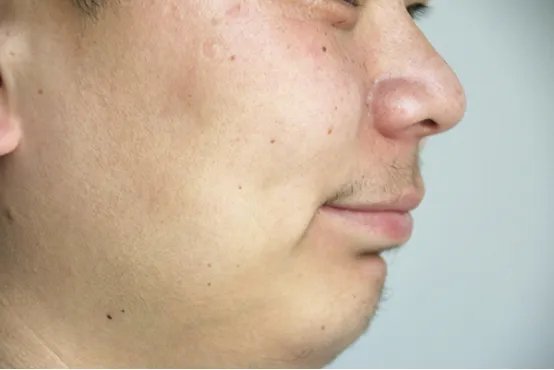 脸上长斑怎样消除