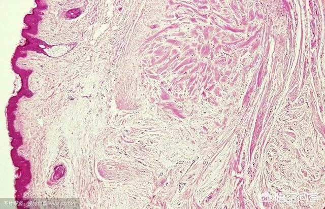 疤痕疙瘩是怎么形成的，有什么好的治疗方法？