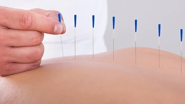 脸上痤疮怎么治