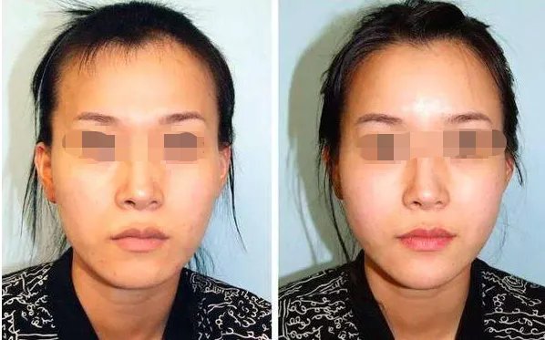 自体脂肪填充面部价格