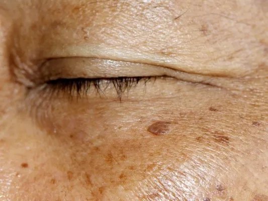 如何控制老年斑