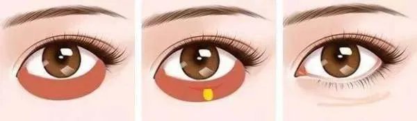 怎样减轻眼袋？