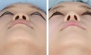 鼻翼缩小前后对比照片