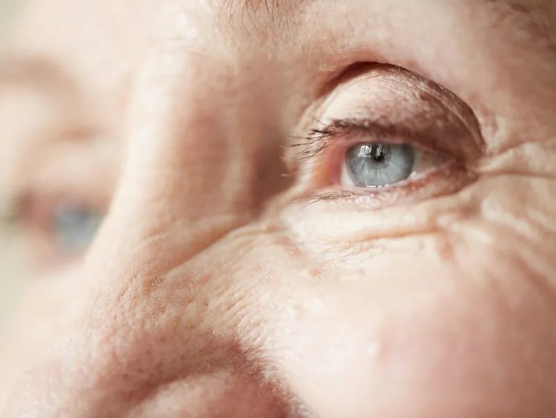 怎么祛除眼角皱纹