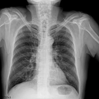 肋骨断了严重吗   肋骨断了如何处理