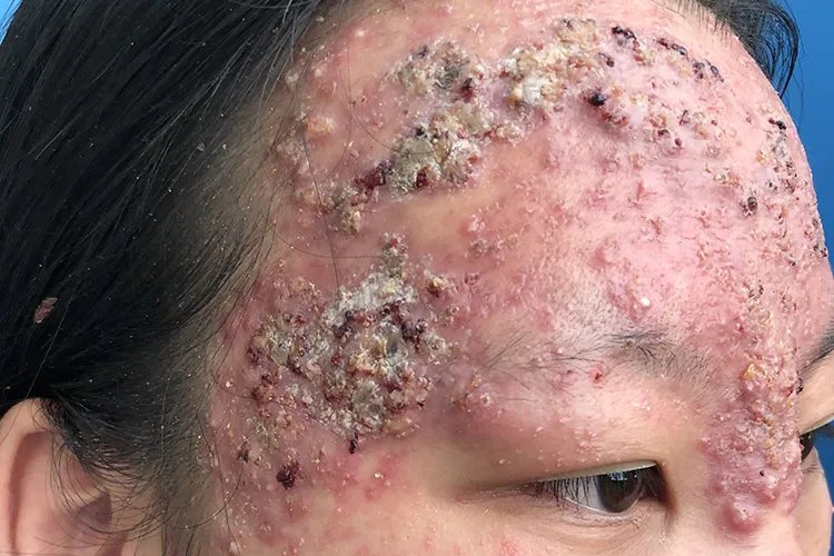 起痘痘的位置和原因