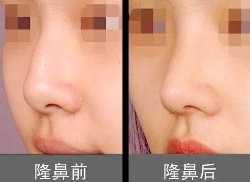 微创隆鼻价格