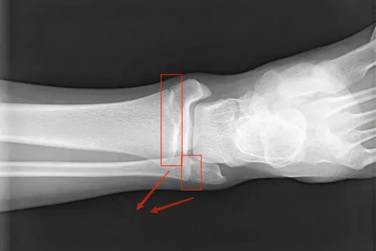 踝关节骨骺线X线图