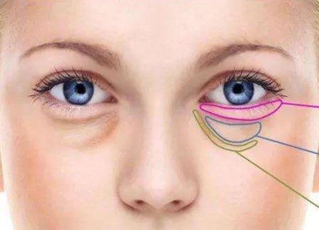 怎样减轻眼袋？