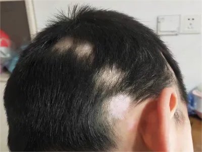 稳定期节段型白癜风头皮白斑图片
