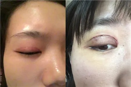 割双眼皮恢复过程图需要多长时间