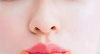 假体隆鼻术后效果自然吗