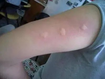 蚊子叮咬及引起的皮肤反应风团图片