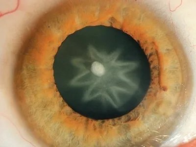 外伤性白内障症状图片