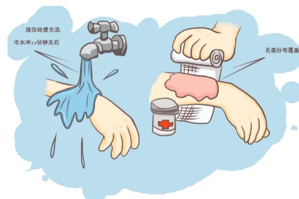 河北一女孩玩火碱重度烧伤，不小心烧伤第一时间该如何处理伤口？