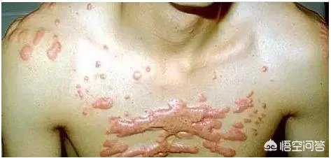 疤痕疙瘩是怎么形成的，有什么好的治疗方法？